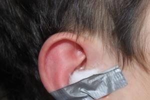 Boric alcohol in the ear: instructions on how to drip for a child, use for otitis Boric alcohol in the ear: instructions for how to drip for a child, use for otitis