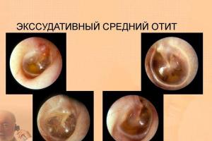 大人と子供の慢性中耳炎の原因、症状、治療